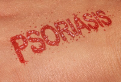 What is psoriasis, and what should I know in Charlotte NC?