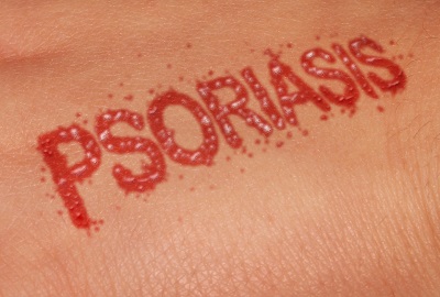 Psoriasis