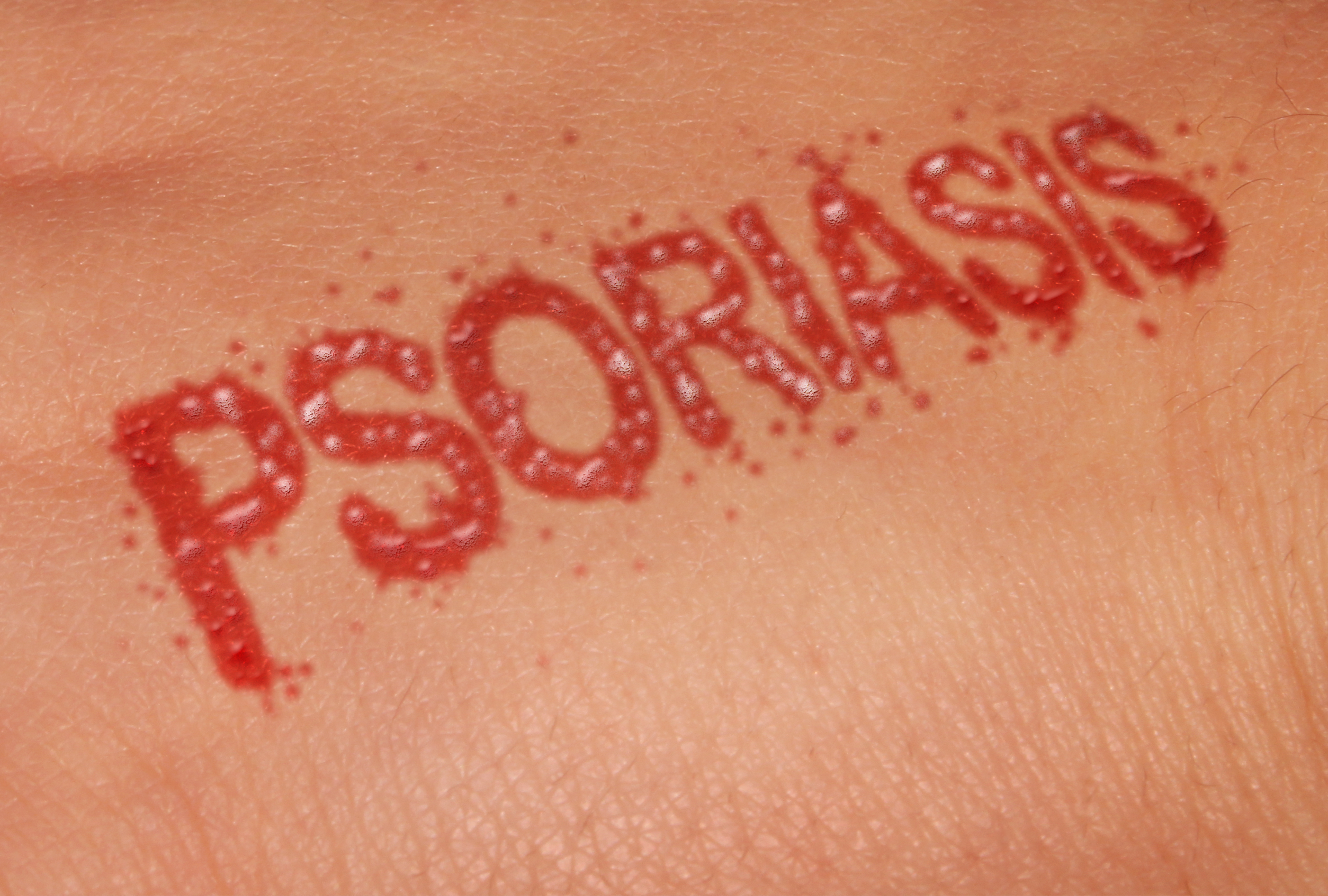 When should I visit a dermatologist for psoriasis in Charlotte, NC?