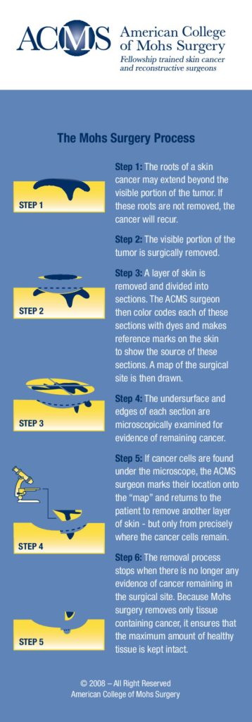 Mohs micrographic surgery- ACMS- Metrolina Dermatology